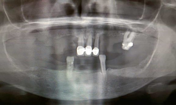 fog implantátum Budapesten